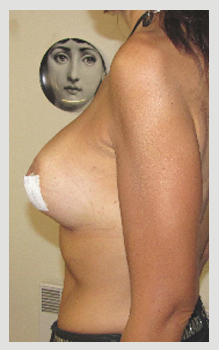 résultat de la mise en place d'un implant de 335gr