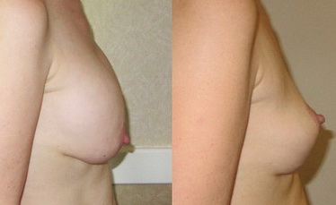 ablation d'implants mammaires vue de profil 