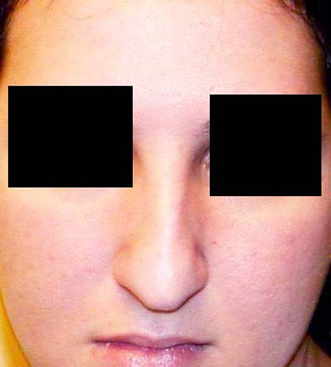 chirurgie-esthetique-interventions-nez-rhinoplasties-000