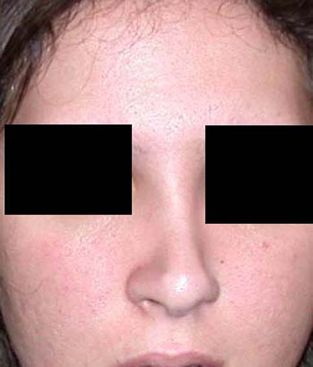 chirurgie-esthetique-interventions-nez-rhinoplasties-001