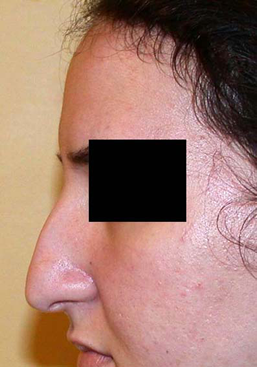 chirurgie-esthetique-interventions-nez-rhinoplasties-002
