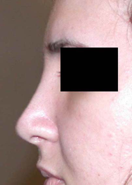 chirurgie-esthetique-interventions-nez-rhinoplasties-003