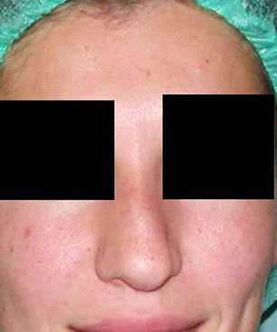 chirurgie-esthetique-interventions-nez-rhinoplasties-004
