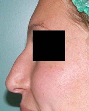 chirurgie-esthetique-interventions-nez-rhinoplasties-006