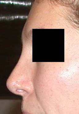 chirurgie-esthetique-interventions-nez-rhinoplasties-007