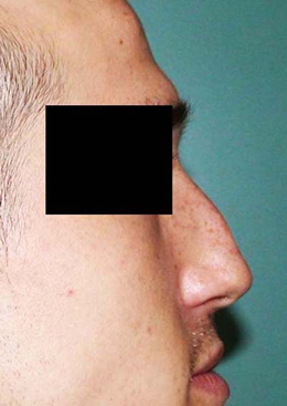 chirurgie-esthetique-interventions-nez-rhinoplasties-008
