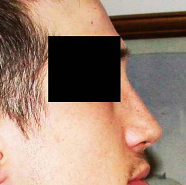 chirurgie-esthetique-interventions-nez-rhinoplasties-009