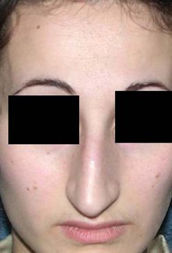 chirurgie-esthetique-interventions-nez-rhinoplasties-010