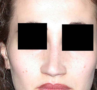 chirurgie-esthetique-interventions-nez-rhinoplasties-011