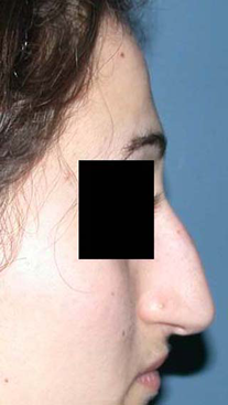chirurgie-esthetique-interventions-nez-rhinoplasties-012