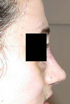 chirurgie-esthetique-interventions-nez-rhinoplasties-013