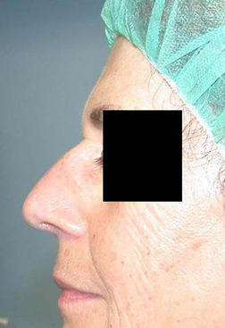 chirurgie-esthetique-interventions-nez-rhinoplasties-014