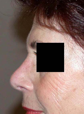 chirurgie-esthetique-interventions-nez-rhinoplasties-015