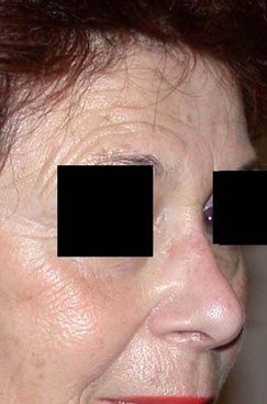 chirurgie-esthetique-interventions-nez-rhinoplasties-016