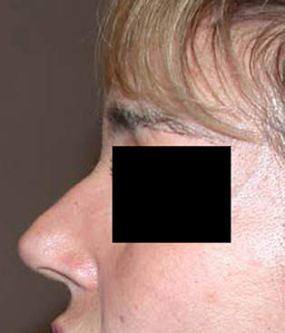 chirurgie-esthetique-interventions-nez-rhinoplasties-017
