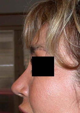 chirurgie-esthetique-interventions-nez-rhinoplasties-018