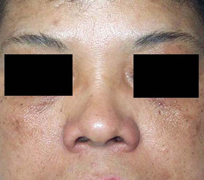 chirurgie-esthetique-interventions-nez-rhinoplasties-019