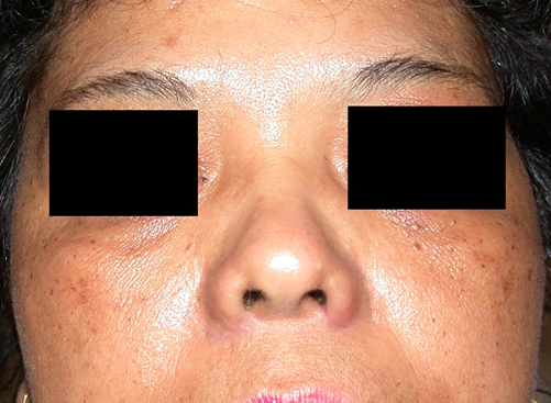 chirurgie-esthetique-interventions-nez-rhinoplasties-020