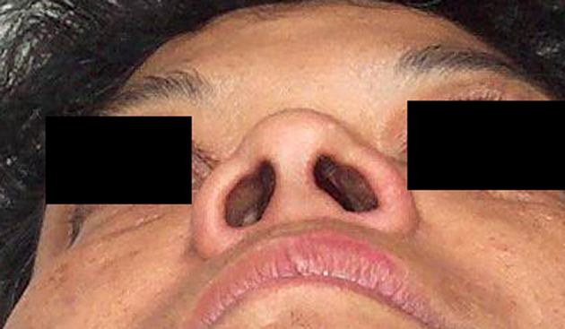 chirurgie-esthetique-interventions-nez-rhinoplasties-021