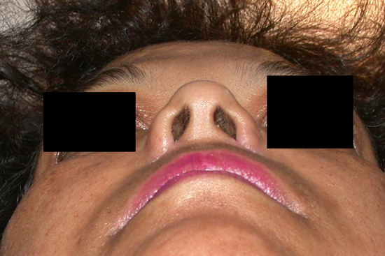chirurgie-esthetique-interventions-nez-rhinoplasties-022