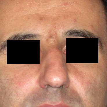 chirurgie-esthetique-interventions-nez-rhinoplasties-023