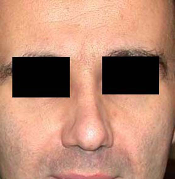 chirurgie-esthetique-interventions-nez-rhinoplasties-024