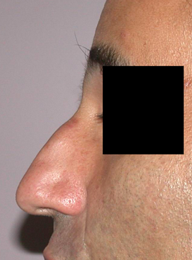 chirurgie-esthetique-interventions-nez-rhinoplasties-025
