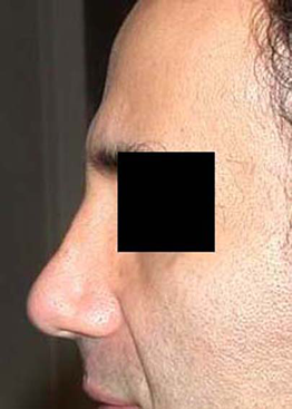 chirurgie-esthetique-interventions-nez-rhinoplasties-026
