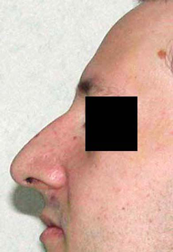 chirurgie-esthetique-interventions-nez-rhinoplasties-027