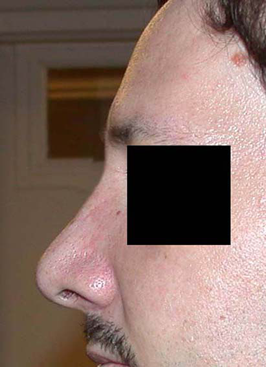 chirurgie-esthetique-interventions-nez-rhinoplasties-028