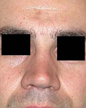 chirurgie-esthetique-interventions-nez-rhinoplasties-029