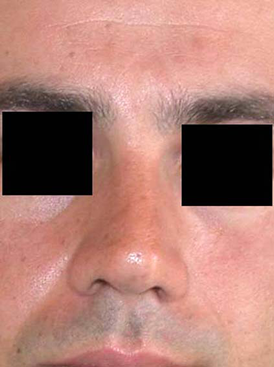 chirurgie-esthetique-interventions-nez-rhinoplasties-030