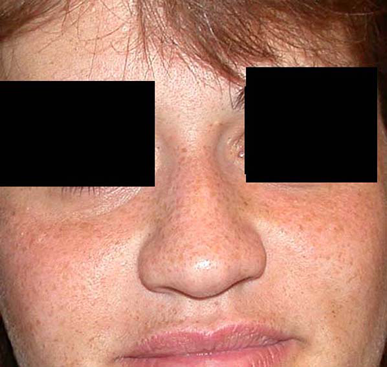 chirurgie-esthetique-interventions-nez-rhinoplasties-031