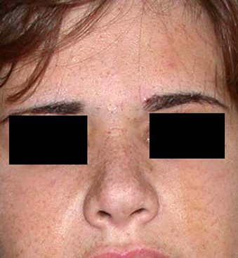 chirurgie-esthetique-interventions-nez-rhinoplasties-032