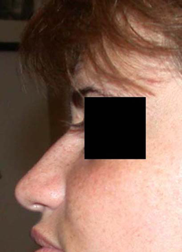 chirurgie-esthetique-interventions-nez-rhinoplasties-033