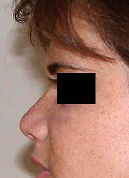 chirurgie-esthetique-interventions-nez-rhinoplasties-034