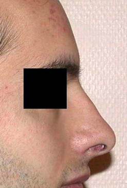 chirurgie-esthetique-interventions-nez-rhinoplasties-035