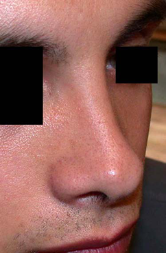 chirurgie-esthetique-interventions-nez-rhinoplasties-036