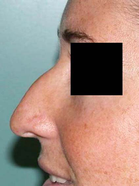 chirurgie-esthetique-interventions-nez-rhinoplasties-037