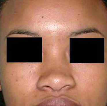 chirurgie-esthetique-interventions-nez-rhinoplasties-039