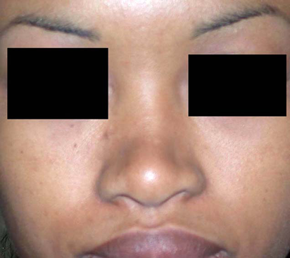 chirurgie-esthetique-interventions-nez-rhinoplasties-040