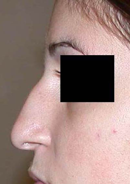 chirurgie-esthetique-interventions-nez-rhinoplasties-041