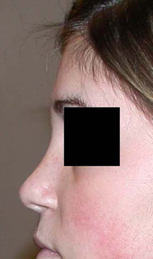 chirurgie-esthetique-interventions-nez-rhinoplasties-042