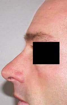 chirurgie-esthetique-interventions-nez-rhinoplasties-043