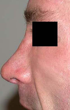chirurgie-esthetique-interventions-nez-rhinoplasties-044