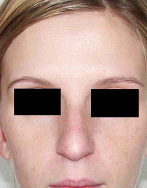 chirurgie-esthetique-interventions-nez-rhinoplasties-045