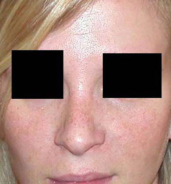 chirurgie-esthetique-interventions-nez-rhinoplasties-046