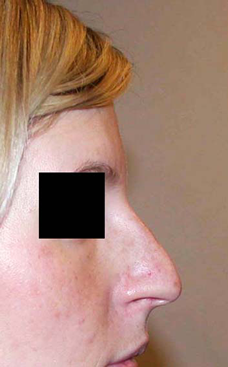 chirurgie-esthetique-interventions-nez-rhinoplasties-047