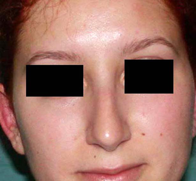 chirurgie-esthetique-interventions-nez-rhinoplasties-049