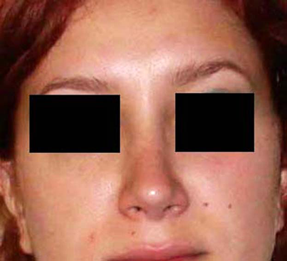 chirurgie-esthetique-interventions-nez-rhinoplasties-050